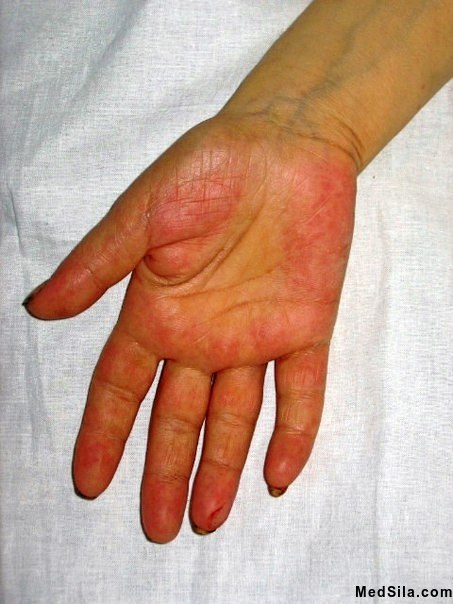 печеночные ладони